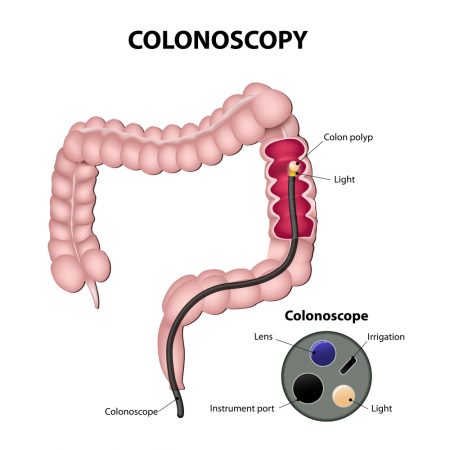 colonoscopy test scarborough